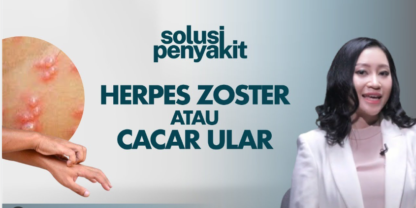 Cacar ular memiliki nama lain, yaitu herpes zoster. Cacar ular sebenarnya merupakan penyakit cacar air yang kambuh kembali.